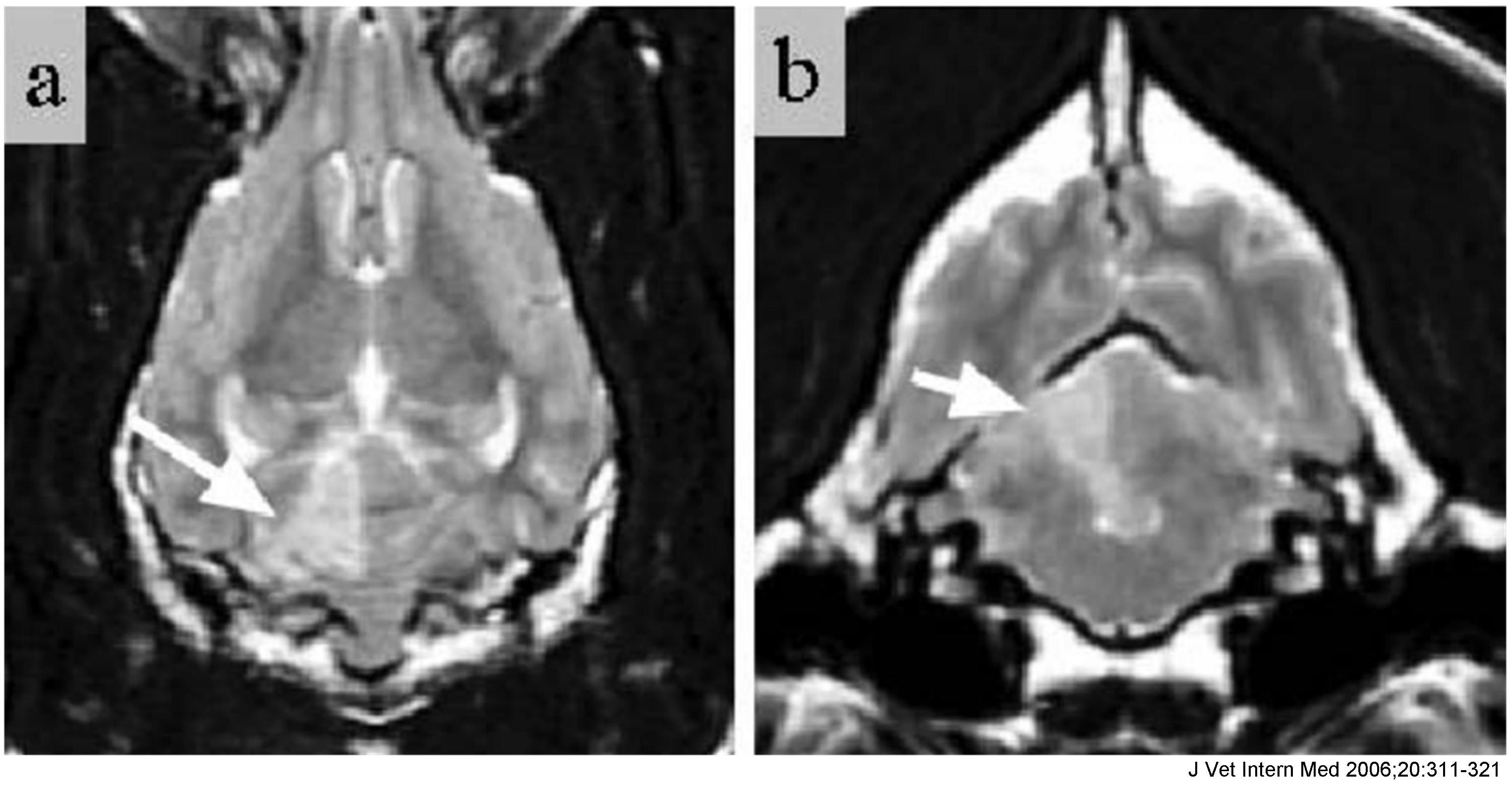 MRI beeld van een herseninfarct