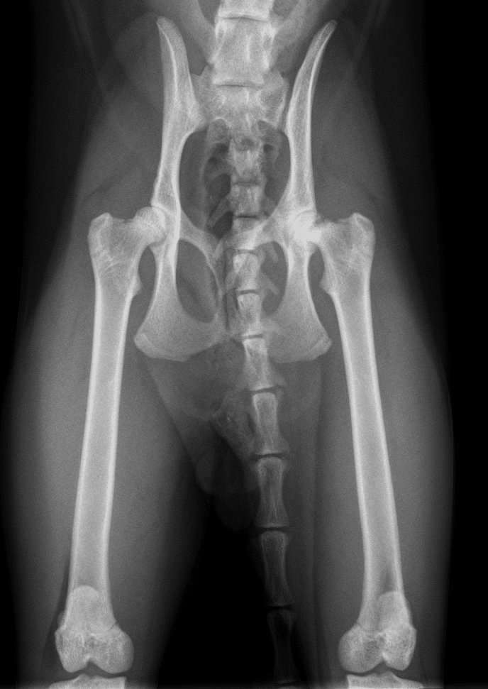 Slipped Femoral Capital Epiphysis